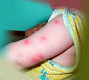 ¡Gran problema para la gente pequeña! Las pulgas pican en un niño lo que es peligroso, qué hacer, así como las fotos.