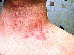 What the bug bites on human skin look like: signs, sizes, symptoms, photos